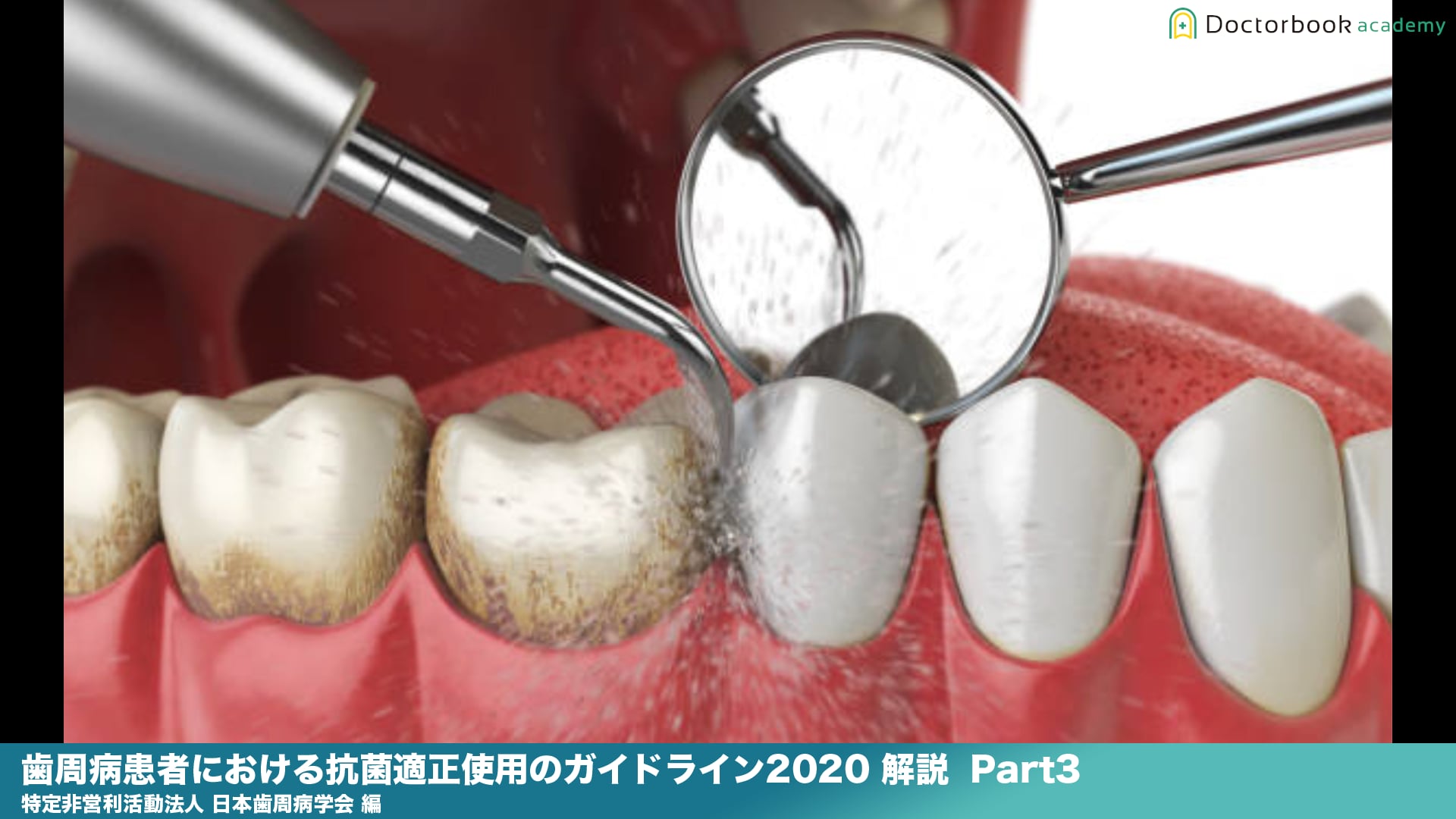 『歯周病患者における抗菌薬適正使用のガイドライン2020 』解説 Part3 