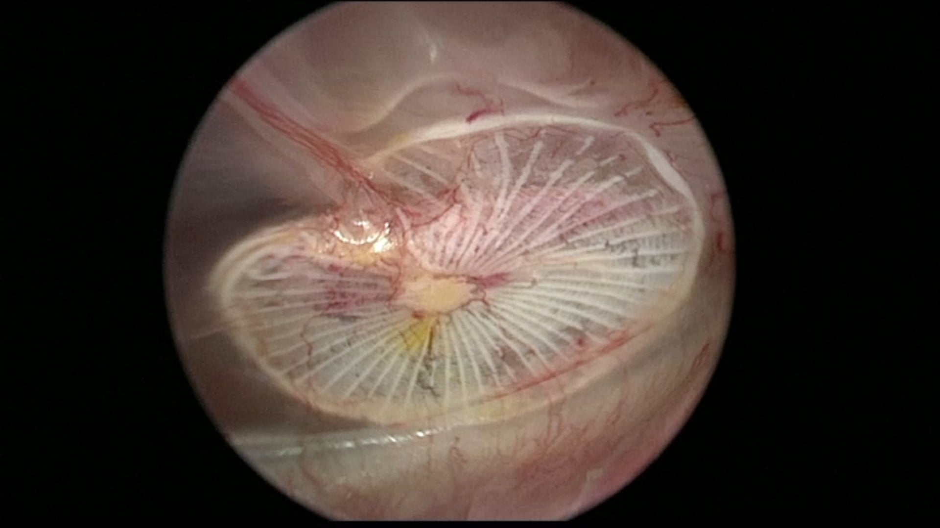 Remodeling PhonoGraft Graft.mp4