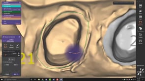 Single Crowns, Margins, Model, Pre-Op.mp4