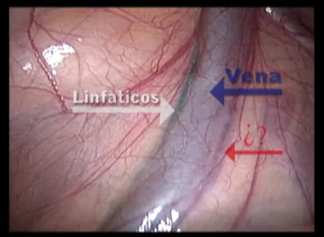 video de cirugia de hidrocele