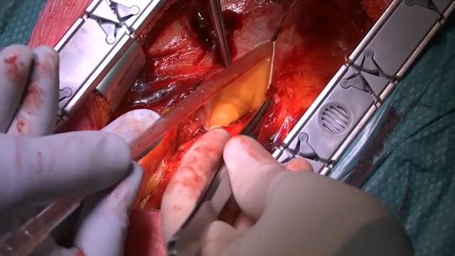 open heart surgery video