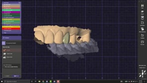 Model Creator for Screw Retained Crown.mp4