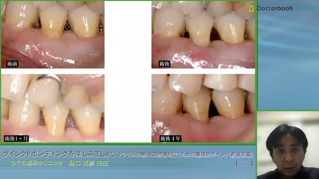 #2 Caries ～歯頸部充填～