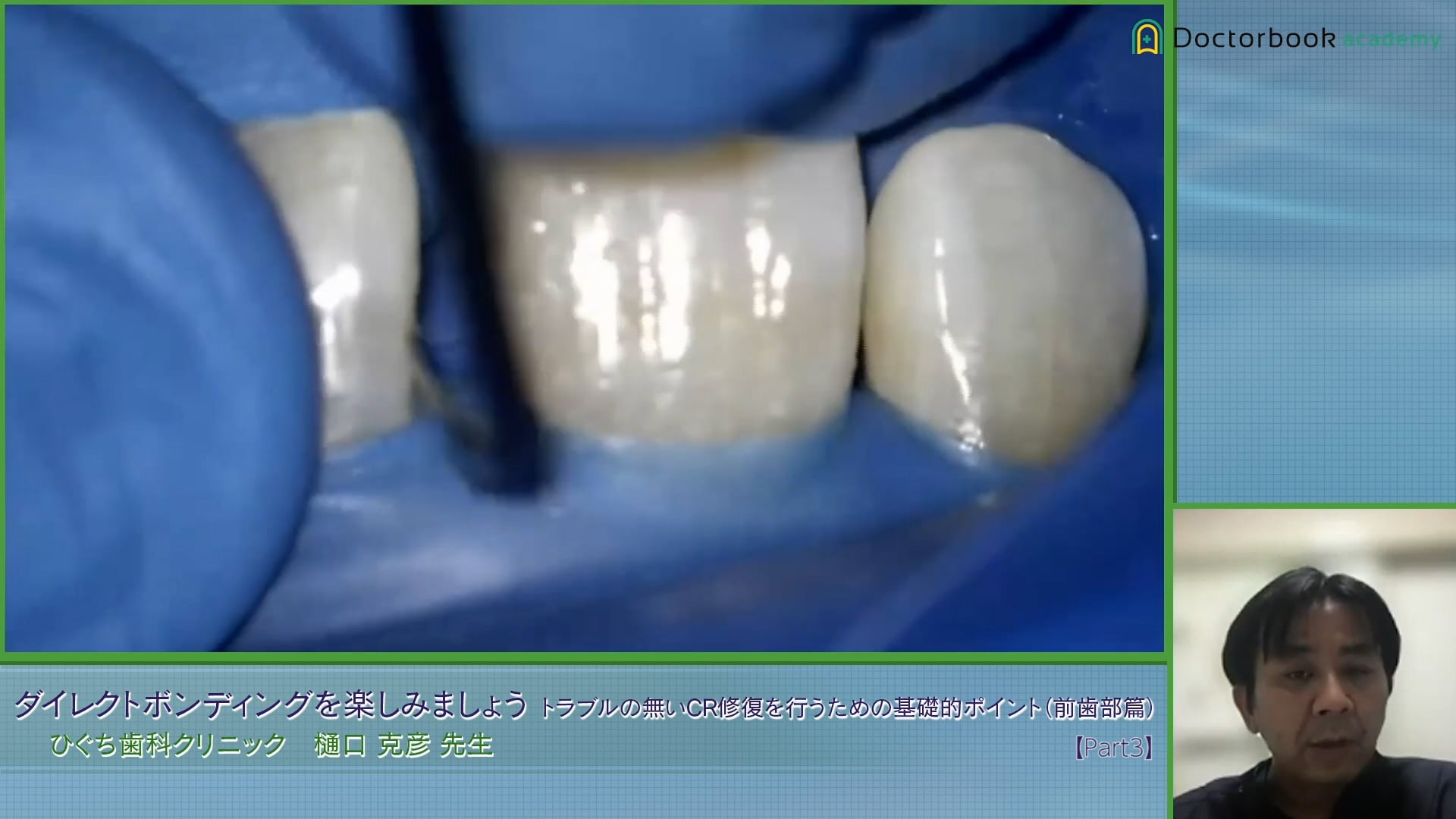 #3 前歯部の隙間をCRで充填した症例