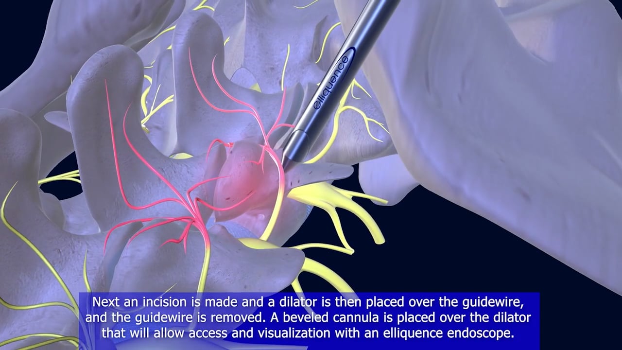 Endoscopic Facet Denervation Animation on Vimeo