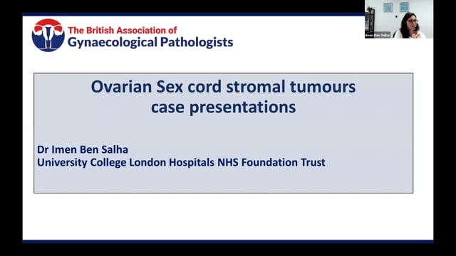 Ovarian Sex cord stromal tumours