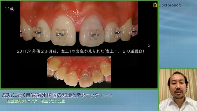 2 歯根未完成歯の移植 | Doctorbook academy (ドクターブックアカデミー)