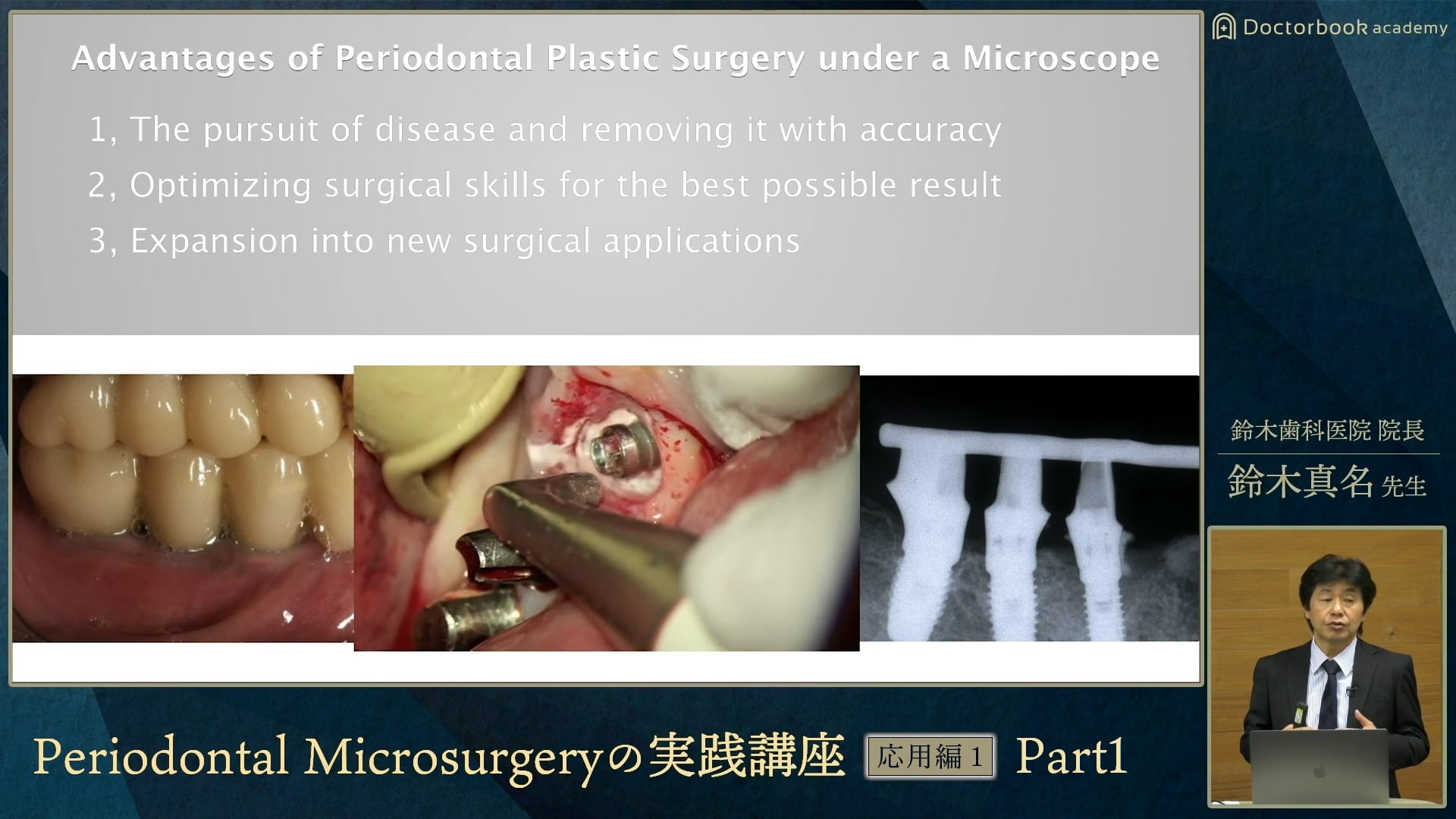 #1 Periodontal Microsurgeryの特徴