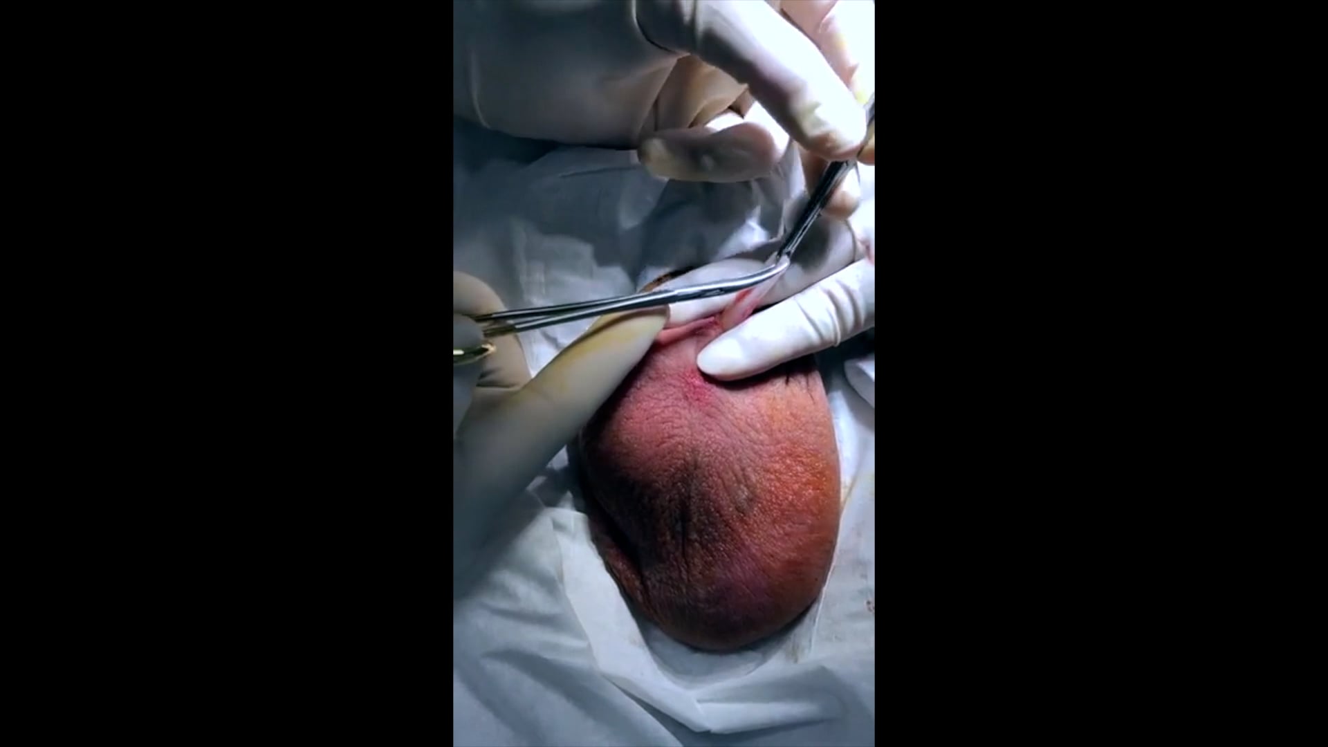 Dr. Pollock Performs No-Scalpel Vasectomy