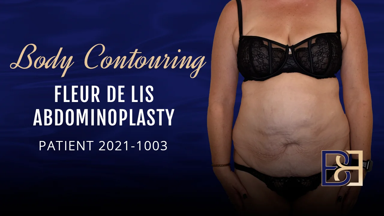Fleur-de-lis Abdominoplasty: Watch her lose 2 litres of fat and tighten  loose skin after sleeve gastrectomy on Vimeo