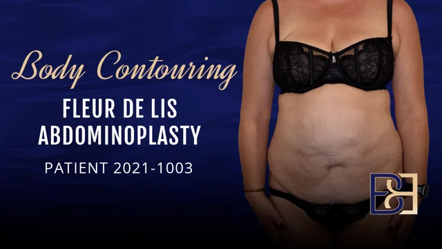 Fleur-de-lis Abdominoplasty Guide - Body Contouring Surgery Clinic