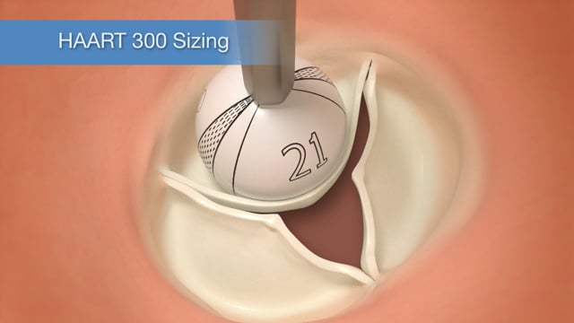 Technique - Sizing - Trileaflet Aortic Valves