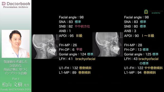 顎運動を考慮した包括的な顎顔面診断に基づくインプラント治療