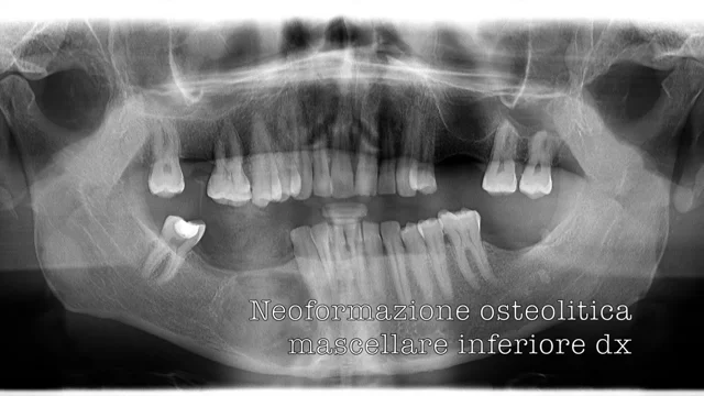 cheratocisti odontogena