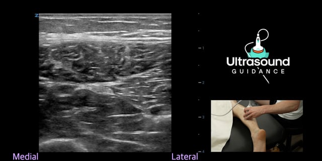 Tibial Nerve Scan