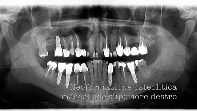 cheratocisti odontogena