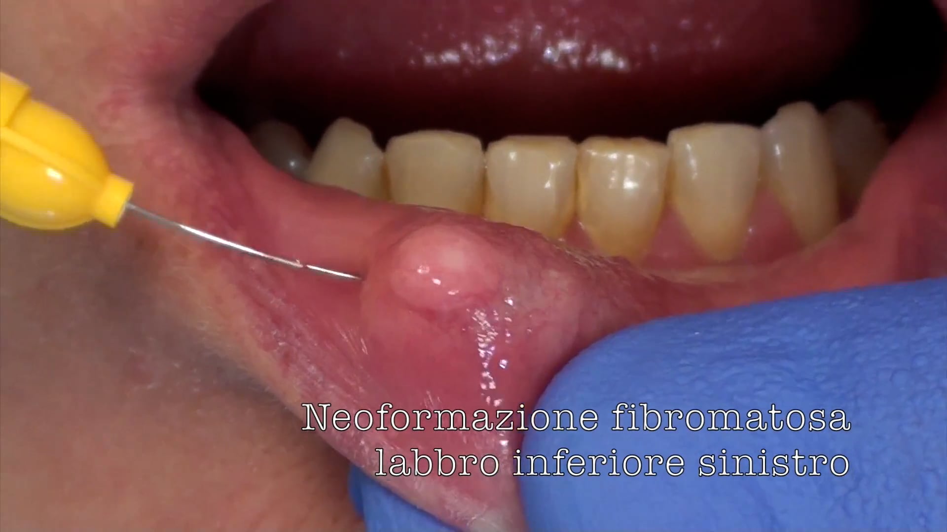 Dott Mariani Umberto Fibroma Mucosa Interna Labbro Inferiore