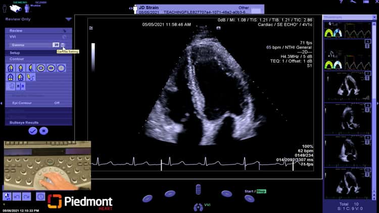 Piedmont Healthcare LV Myocardial Strain Workflow on Siemens SC200 on Vimeo