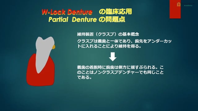 W-Lock Dentureの臨床応用 | Doctorbook academy (ドクター