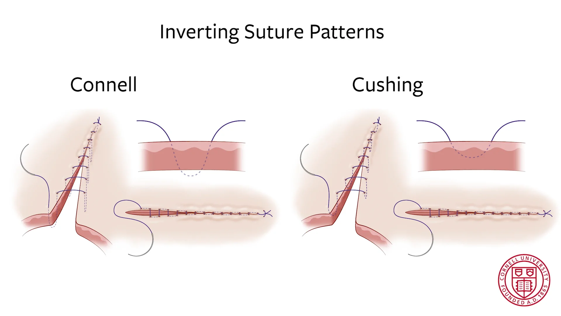 Connell suture deals