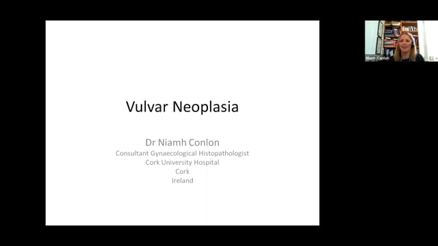 Vulval Neoplasia