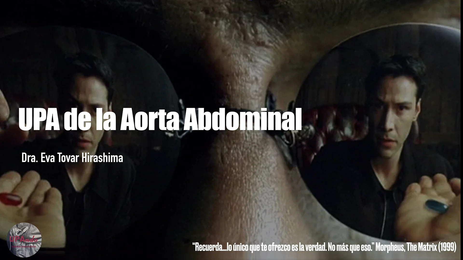 UPA Aorta Abdominal.mp4