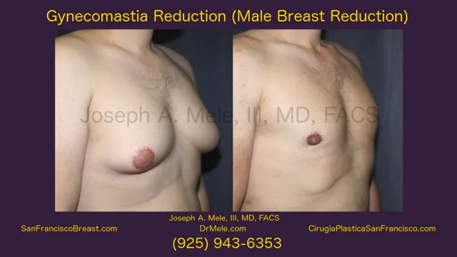 Gynecomastia Reduction Video Breast Reduction for Men 16