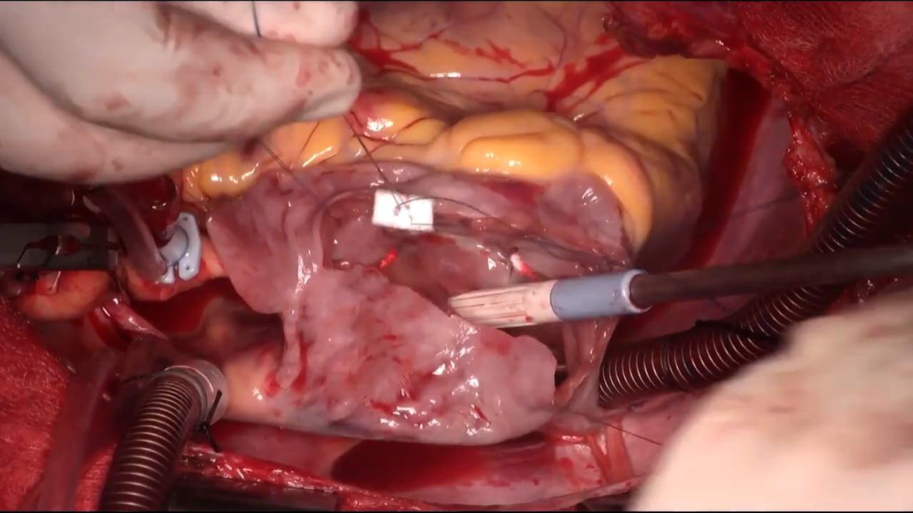 Excision of a left atrial myxoma with mitral and tricuspid valve repair ...