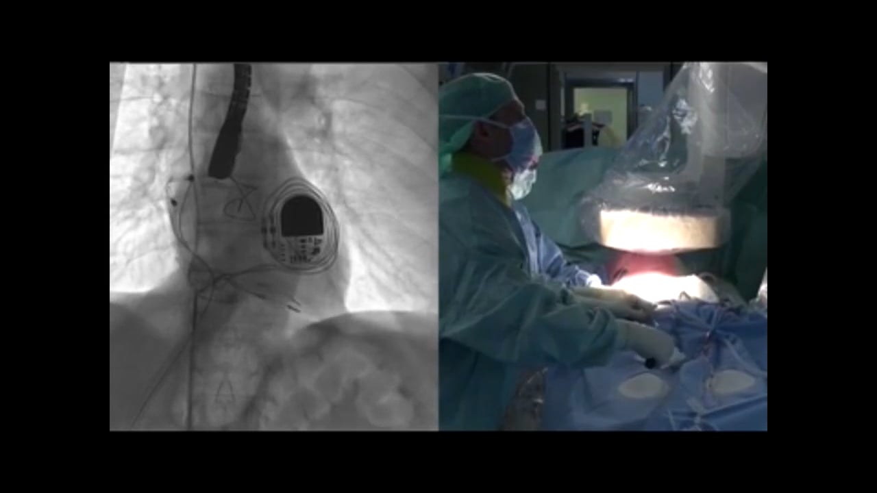 Lead extraction technology and techniques: A surgeon’s perspective | MMCTS