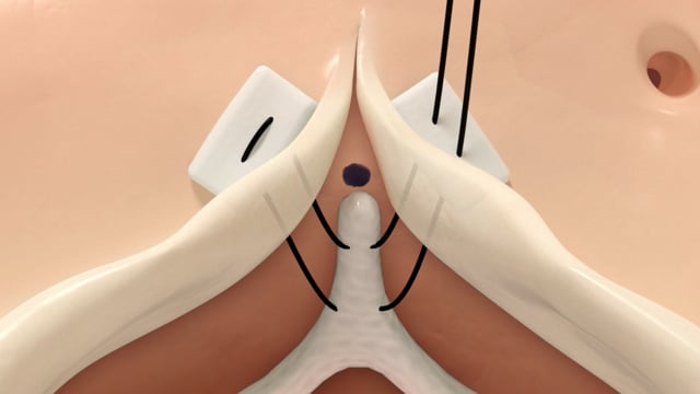 Technique - Device Placement / Suturing