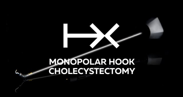 cholecystectomy