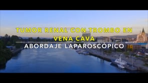 TUMOR RENAL CON TROMBO EN VENA CAVA, ABORDAJE LAPAROSCÓPICO