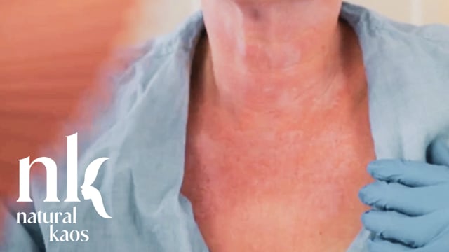 30% TCA Peel Neck & Chest Natural Kaos Skincare Chemical Peel