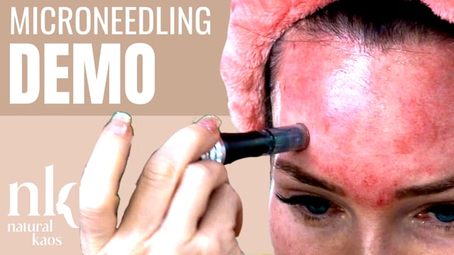 Microneedling Demonstration video
