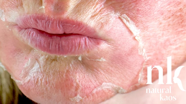 20%TCA + 30% Jessner's Acid Peel Natural Kaos Skincare