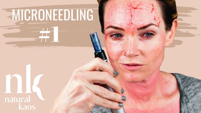MICRONEEDLING Session #1 Natural Kaos Skincare