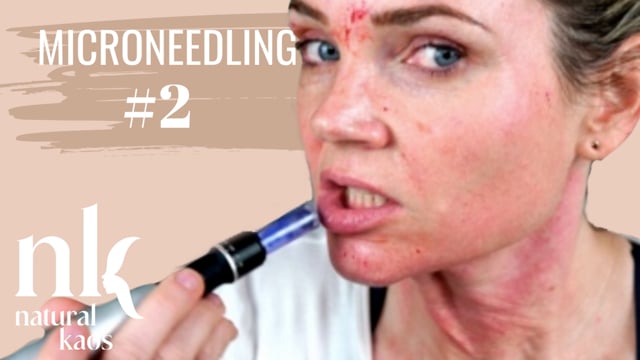 MICRONEEDLING Session #2 Natural Kaos Skincare