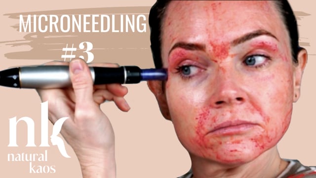 MICRONEEDLING Session #3 Natural Kaos Skincare