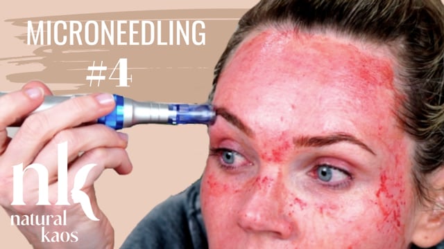 MICRONEEDLING Session #4 Natural Kaos Skincare