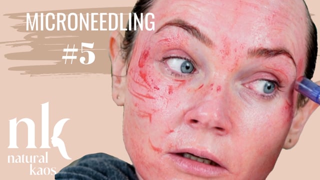 MICRONEEDLING Session #5 Natural Kaos Skincare