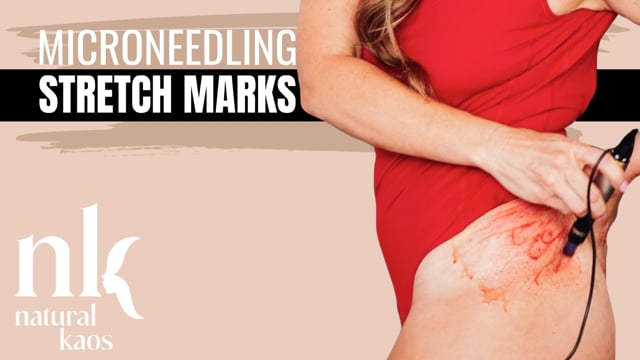 MICRONEEDLING Body Stretch Marks video