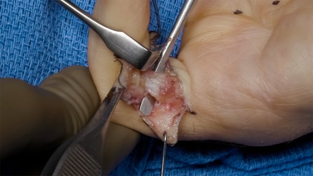 Segmental Fasciectomy and Needle Aponeurotomy for Surgical Management of Dupuytren’s Disease