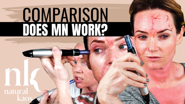 Does Microneedling work? Comparison of 7 Sessions video