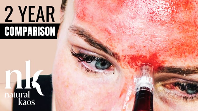 Skin Progress, 2 Year Microneedling Comparison video