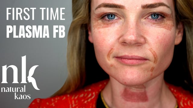 First PLASMA FIBROBLAST Skin Tightening Experience, Natural Kaos Skincare