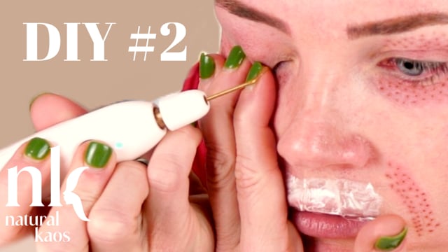 Plasma Fibroblast DIY #2 Session, Natural Kaos Skincare