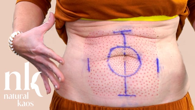 Plasma Fibroblast My Stomach Skin, Natural Kaos Skincare