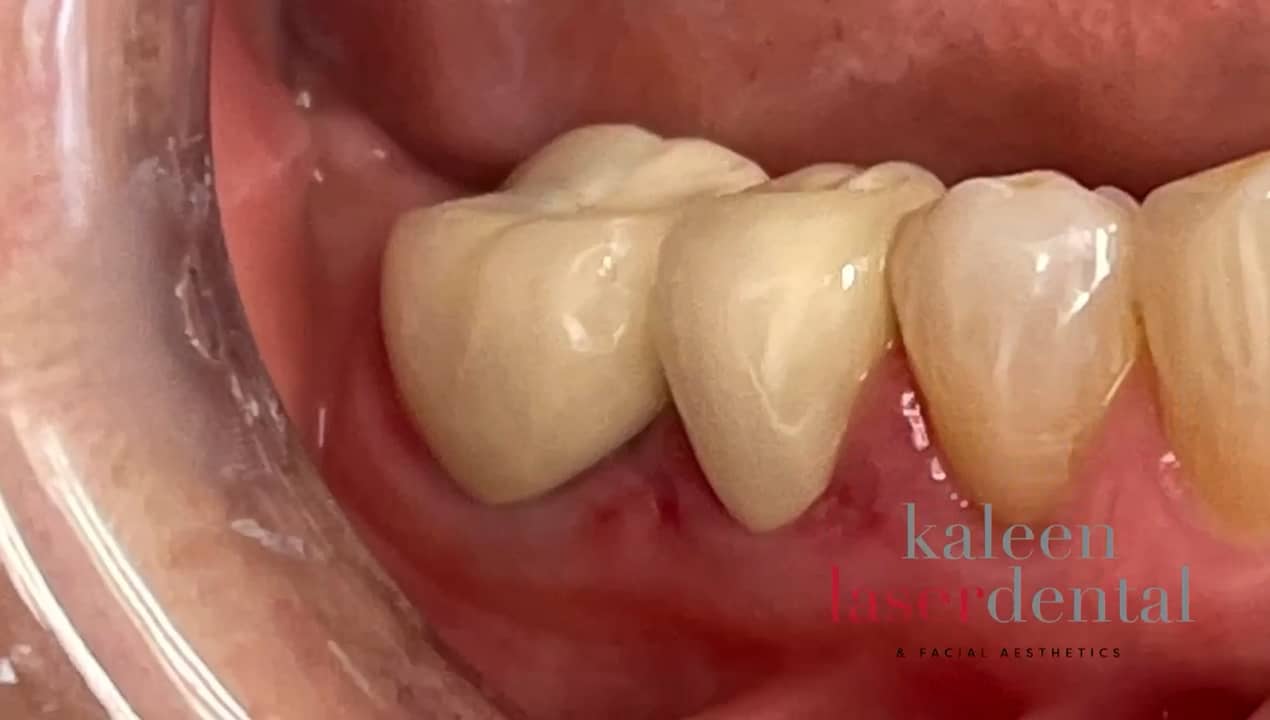 Zirconia Crown Removal on Vimeo