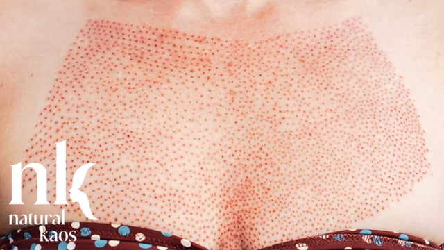 Plasma Fibroblast Chest 2021 Natural Kaos Skincare