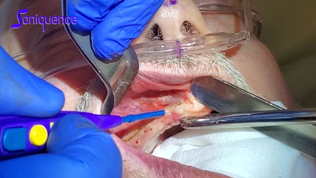 Dental Surgery with Dr. Ryan Diepenbrock